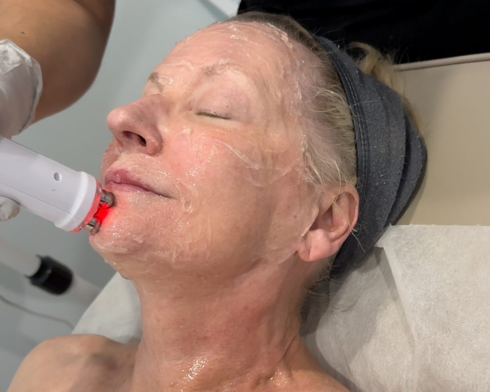 RF facial